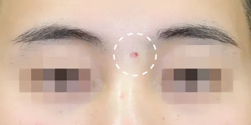 治療直後