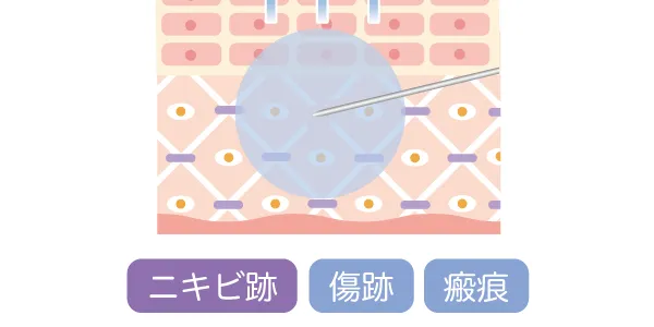 サブシジョン