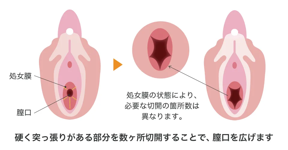処女膜の説明