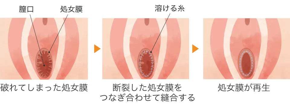 手術方法
