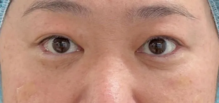治療後