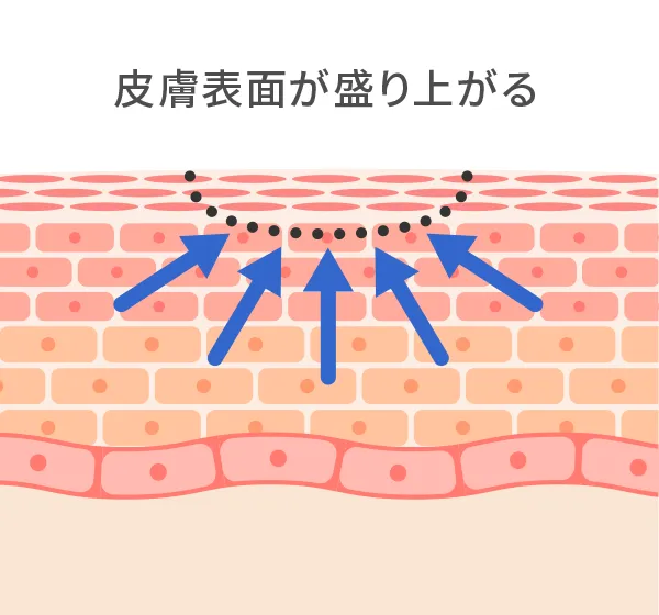 エルビウムヤグレーザー照射イメージ