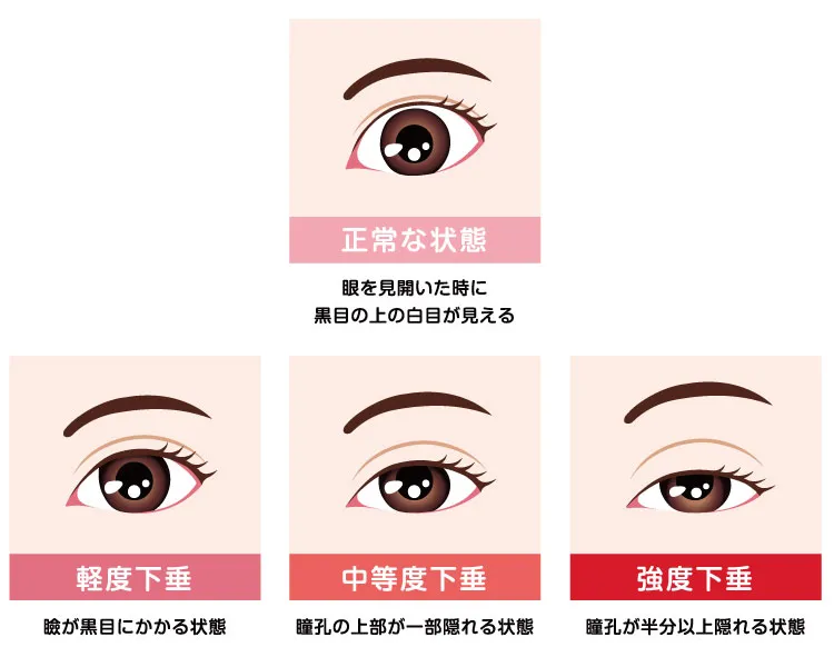 眼瞼下垂の重症度