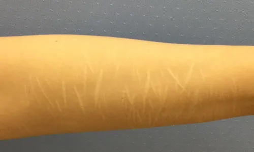 施術前