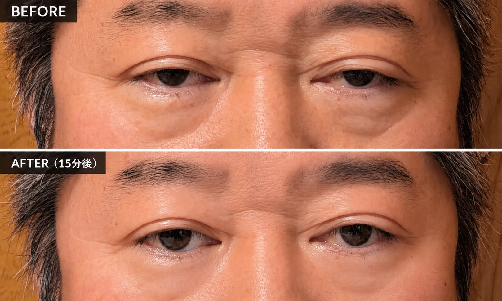 アップニーク症例写真